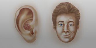 Kulak Çevresinde Kabarcıklar Tehlike İşareti Olabilir! Ramsay Hunt Sendromuna Dikkat