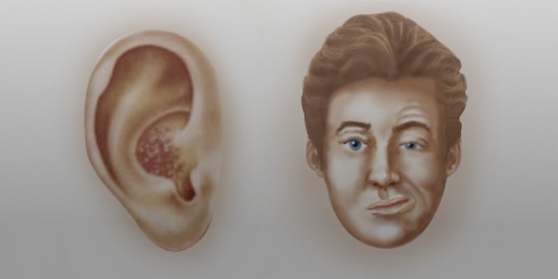 Kulak Çevresinde Kabarcıklar Tehlike İşareti Olabilir! Ramsay Hunt Sendromuna Dikkat